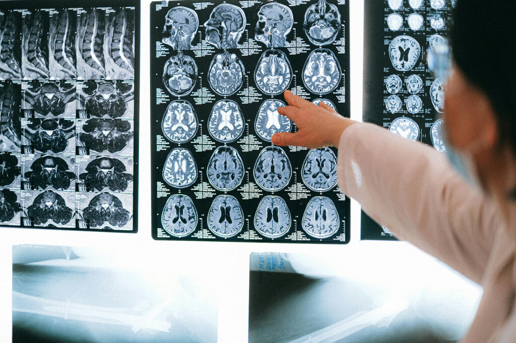 How Doctors Classify TBI Severity - Traumatic Brain Injury