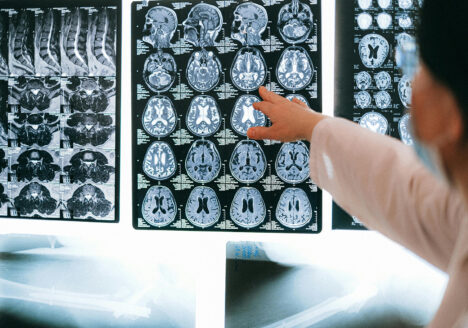 A doctor pointing at brain scans on a lightboard, illustrating how medical professionals assess the severity of traumatic brain injuries.