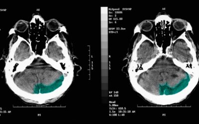 This diagnostic resource highlights the clinical application of Non-contrast Computed Tomography (NCCT) brain scans, NCCT remains the frontline gold standard for neuroimaging in emergency settings, offering rapid visualization of the human brain and head. This file is licensed under the Creative Commons Attribution 4.0 International license.