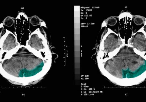 This diagnostic resource highlights the clinical application of Non-contrast Computed Tomography (NCCT) brain scans, NCCT remains the frontline gold standard for neuroimaging in emergency settings, offering rapid visualization of the human brain and head. This file is licensed under the Creative Commons Attribution 4.0 International license.
